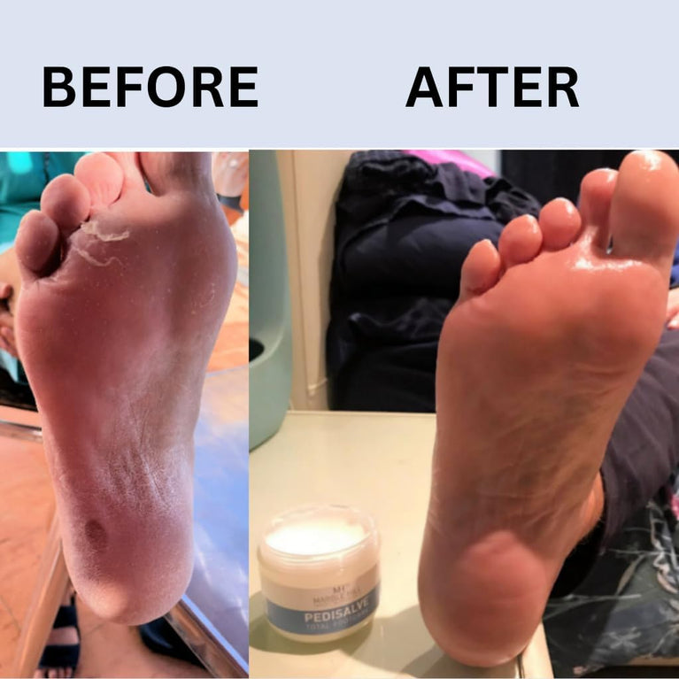 PediSalve Diabetic-Friendly Foot Cream - Intensive Moisturizer for Dry Rough Skin, Eczema, Cracked Heels, Brittle Nails 100g