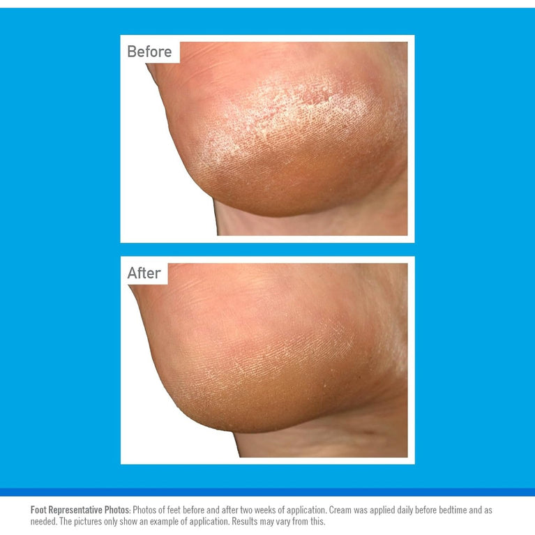 O’Keeffe’s Overnight Revitalizing Foot Cream, 80ml – Advanced Solution for Severe Dry, Cracked Feet