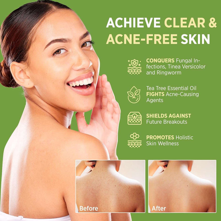 Antifungal Antibacterial Tea Tree Soap: Tea Tree Oil Soap for Face & Body Acne - Antifungal Antibacterial Treatment Soap for Athlete's Foot Tinea Versicolor Folliculitis Ringworm Jock Itch - 2 Pack