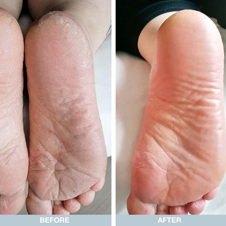Revitalizing Foot Cream by Australian Bodycare - 100ml | Callus Softening Treatment for Dry & Cracked Feet with 10% Urea