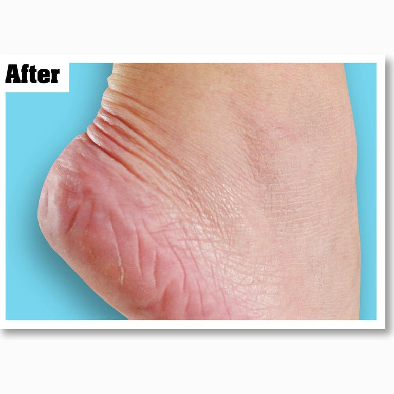 O'Keeffe's Superior Hydration Foot Cream, 80ml – Ultimate Solution for Severely Dry, Cracked Feet
