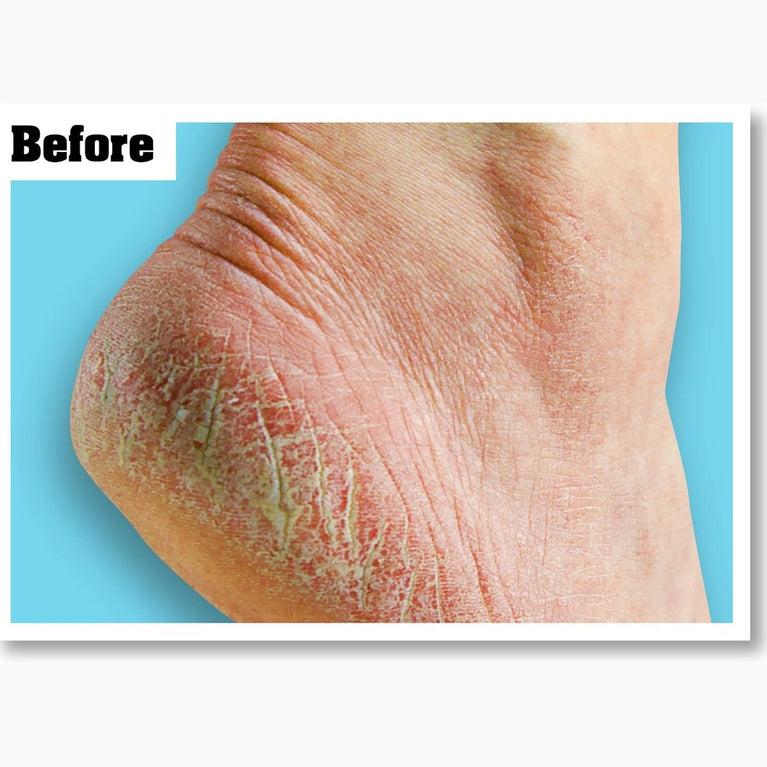 O'Keeffe's Superior Hydration Foot Cream, 80ml – Ultimate Solution for Severely Dry, Cracked Feet