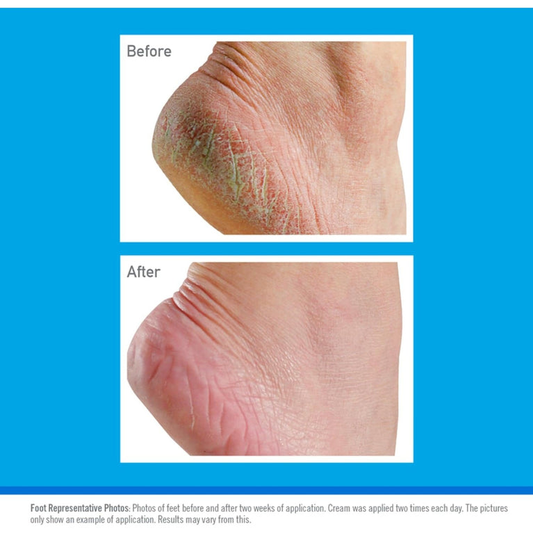 O'Keeffe's Intensive Hydration Foot Cream, 180g – Restorative Solution for Extremely Dry and Cracked Feet