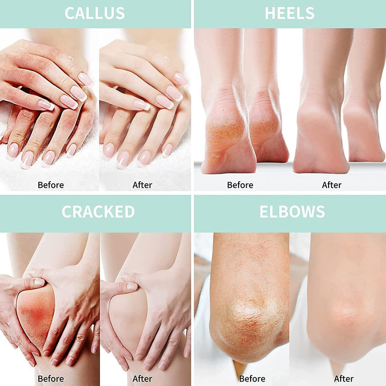 Intensive Moisturizing Urea Foot Cream with Salicylic Acid, Hyaluronic Acid, Tea Tree & Aloe Vera 5.29 oz