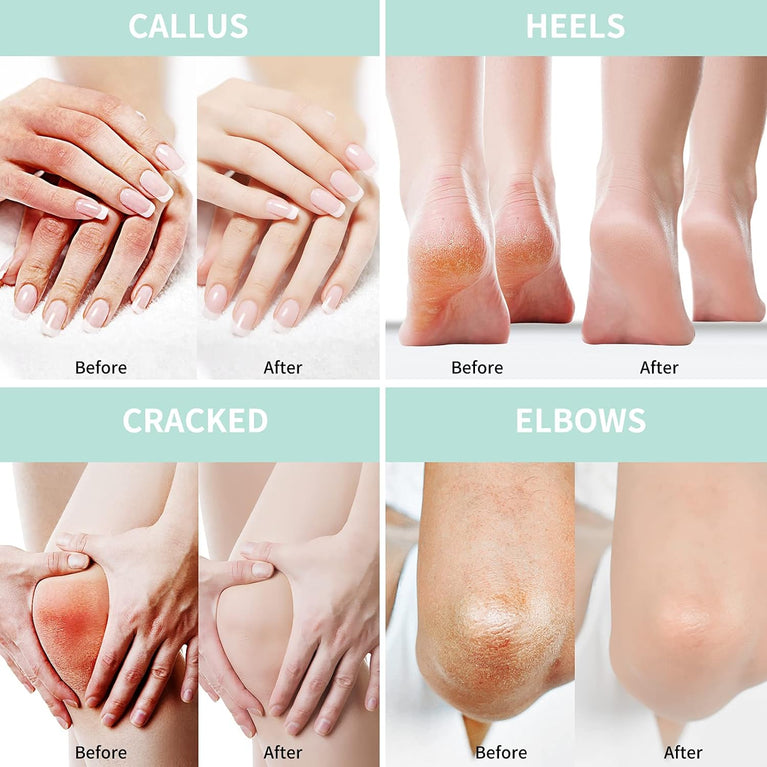 Intensive Moisturizing Urea Foot Cream with Salicylic Acid, Hyaluronic Acid, Tea Tree & Aloe Vera 5.29 oz