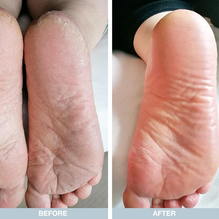 Revitalizing Foot Cream by Australian Bodycare - 100ml | Callus Softening Treatment for Dry & Cracked Feet with 10% Urea